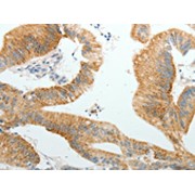 IHC-P analysis of Human colon cancer tissue, using PGBD5 antibody (1/20 dilution, 200X magnification).