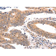 IHC-P analysis of human colon cancer tissue, using SEMA3G antibody (1/30 dilution, 200x magnification).