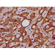 IHC-P analysis of human liver cancer tissue, using SLC15A4 antibody (1/200 dilution). After dewaxing and hydration, antigen retrieval was mediated by high pressure in a citrate buffer (pH 6.0). The section was blocked with 10% normal goat serum for 30 min at RT. Then primary antibody (1% BSA) was incubated at 4 °C overnight. The primary is detected by a biotin-conjugated secondary antibody and visualized using an HRP-conjugated SP system.