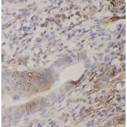 IHC-P analysis of human colon cancer tissue, using PAXI antibody (1/200 dilution).