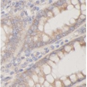 IHC-P analysis of human colon cancer tissue, using A2MG antibody (1/100 dilution).
