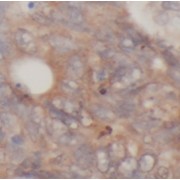 IHC-P analysis of human colon cancer tissue, using CYP27A1 antibody (1/200 dilution).