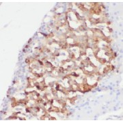 IHC-P analysis of human pancreas cancer tissue, using AGTRAP antibody (1/10 dilution).