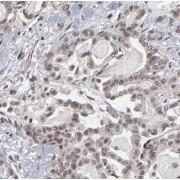 IHC-P analysis of human pancreas cancer tissue, using B3GALT4 antibody (1/100 dilution).