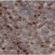 IHC-P analysis of human liver cancer tissue, using C10orf125 Antibody (1/50 dilution).