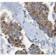 IHC-P analysis of human colon cancer tissue, using CCDC56 Antibody (1/50 dilution).