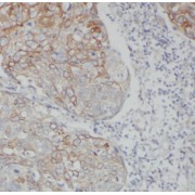 IHC-P analysis of human colon cancer tissue, using CEA antibody (1/50 dilution).