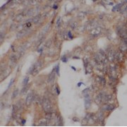 IHC-P analysis of human colon cancer tissue, using CEACAM3-Specific antibody (1/50 dilution).