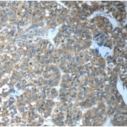 IHC-P analysis of human breast cancer tissue, using CFTR antibody (1/50 dilution).