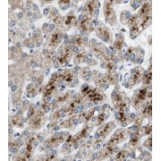 IHC-P analysis of human liver cancer tissue, using CYP2C8 antibody (1/500 dilution).