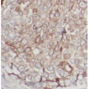 IHC-P analysis of human breast cancer tissue, using ERBB3 Antibody (1/200 dilution).
