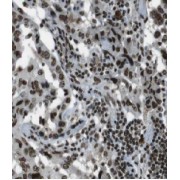 IHC-P analysis of human lung cancer tissue, using FAM107A antibody (1/50 dilution).