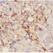 IHC-P analysis of human breast cancer tissue, using GCDFP-15, PIP antibody (1/50 dilution).