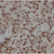 IHC-P analysis of human breast cancer tissue, using GNL2 antibody (1/50 dilution).