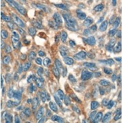 IHC-P analysis of human skin cancer tissue, using IL-19 antibody (1/50 dilution).