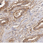 IHC-P analysis of human pancreas cancer tissue, using KCNF1 antibody (1/100 dilution).