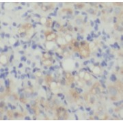 IHC-P analysis of human ovary tumor tissue, using LAMR1, RPSA antibody (1/50 dilution).