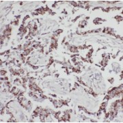 IHC-P analysis of human lung cancer tissue, using MPP3 antibody (1/50 dilution).