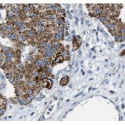 IHC-P analysis of human colon cancer tissue, using MYO7B antibody (1/50 dilution).