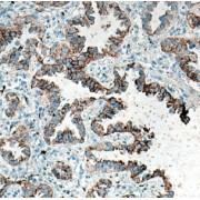 IHC-P analysis of human lung cancer tissue, using Napsin A antibody (1/100 dilution).