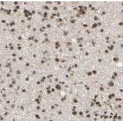 IHC-P analysis of human glioma tissue, using NXF3 antibody (1/50 dilution).
