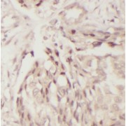 IHC-P analysis of human breast cancer tissue, using OSTF1 antibody (1/100 dilution).