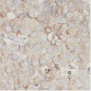 IHC-P analysis of human breast cancer tissue, using PCDHGC3 antibody (1/100 dilution).