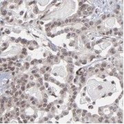 IHC-P analysis of human pancreas cancer tissue, using PLCD4 antibody (1/50 dilution).