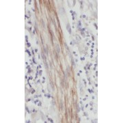 IHC-P analysis of human breast cancer tissue, using PRELID1 Antibody (1/200 dilution).