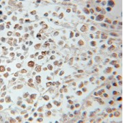 IHC-P analysis of human lymphoma tissue, using PROX1 antibody (1/50 dilution).