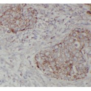 IHC-P analysis of human breast cancer tissue, using RNF34 antibody (1/50 dilution).