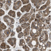 IHC-P analysis of human liver cancer tissue, using RPL36AL antibody (1/50 dilution).