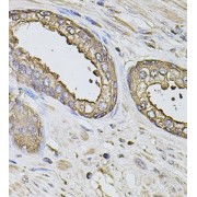 IHC analysis of paraffin-embedded human liver injury, using S100A12 Antibody (1/100 dilution).