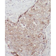 IHC-P analysis of human breast cancer tissue, using ST6GALNAC5 antibody (1/100 dilution).