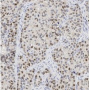 IHC-P analysis of human cervical cancer tissue, using TAF9B antibody (1/100 dilution).