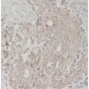 IHC-P analysis of human breast cancer tissue, using TGF-alpha antibody (1/50 dilution).