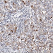 IHC-P analysis of human endometrial cancer tissue, using THG1L antibody (1/100 dilution).