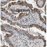 IHC-P analysis of human thyroid cancer tissue, using Thyroglobulin antibody (1/200 dilution).