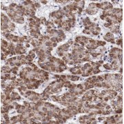 IHC-P analysis of human liver cancer tissue, using TP53INP1 antibody (1/50 dilution).