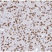 IHC-P analysis of human gliomas tissue, using TSNAX antibody (1/50 dilution).