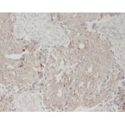 IHC-P analysis of human breast cancer tissue, using WDFY3 antibody (1/50 dilution).