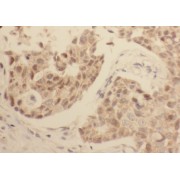 IHC-P analysis of human breast cancer tissue, using WDR38 Antibody (1/50 dilution).