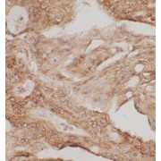 IHC-P analysis of human intestinal cancer tissue, using putrescine antibody (1/200 dilution).