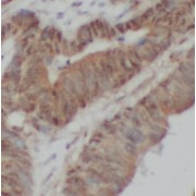 IHC-P analysis of human colon cancer tissue, using ABCA4 antibody (1/100 dilution).