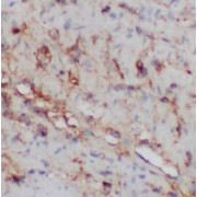 IHC-P analysis of human colon cancer tissue, using MYF5 antibody (1/200 dilution).