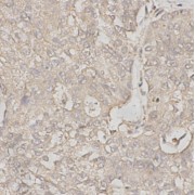 IHC-P analysis of human breast cancer tissue, using TENA antibody (1/200 dilution).