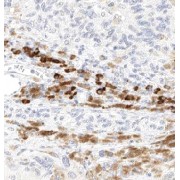IHC-P analysis of human melanoma tissue, using ABCB5 antibody (1/100 dilution).