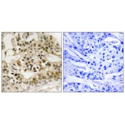 Immunohistochemistry analysis of paraffin-embedded human breast carcinoma tissue using Myb (Phospho-Ser532) antibody.