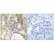 Immunohistochemistry analysis of paraffin-embedded human breast carcinoma tissue using LATS1/2 antibody.