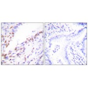 Immunohistochemistry analysis of paraffin-embedded human lung carcinoma tissue, using Ki67antibody.